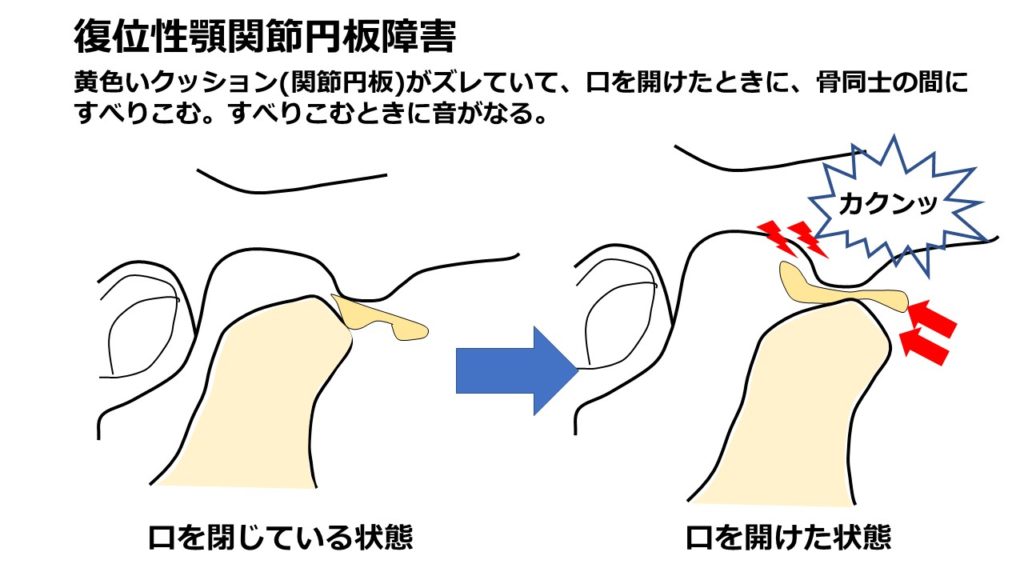 アゴを動かすと音がなる ー 顎関節症の話 ー | 青葉台で歯医者なら【みどり小児歯科】